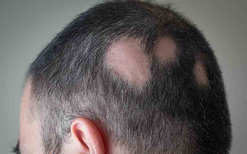 Haarpigmentierung-Alopecia